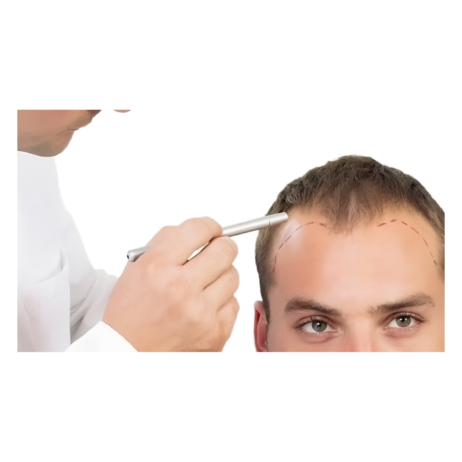 Hair Transplant